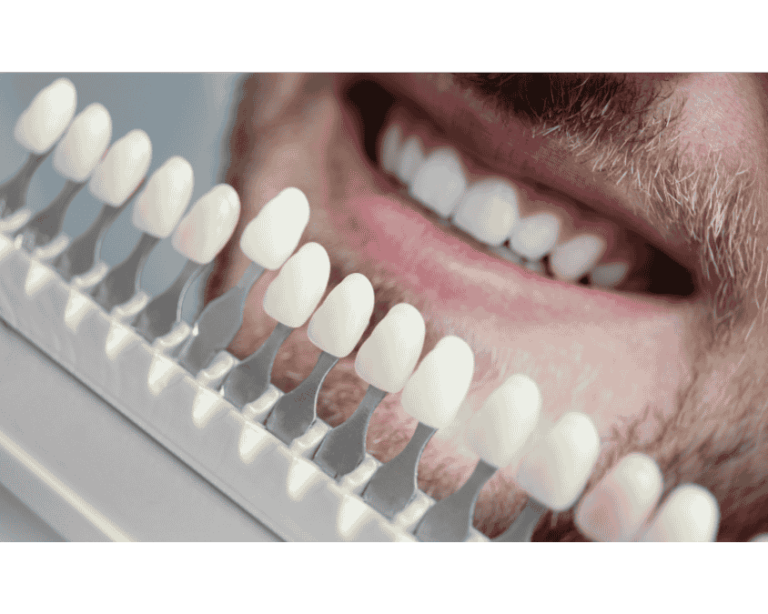 Best Dental veneers service In Ahmedabad