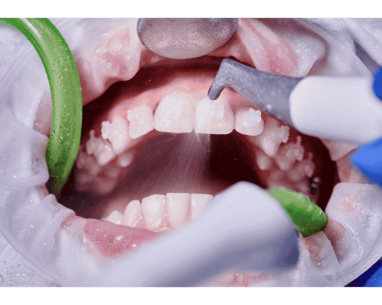 Best Teeth Cleaning Service in Ahmedabad